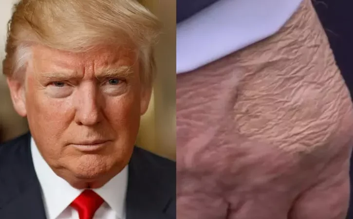 ‘Trump has only 6–8 months to live’: Viral video fuels health rumors as claims of heart failure and kidney disease spread