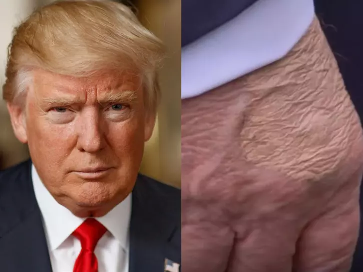 ‘Trump has only 6–8 months to live’: Viral video fuels health rumors as claims of heart failure and kidney disease spread